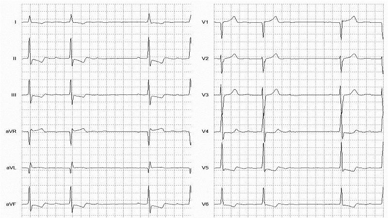 2° A block 12 Lead EKG